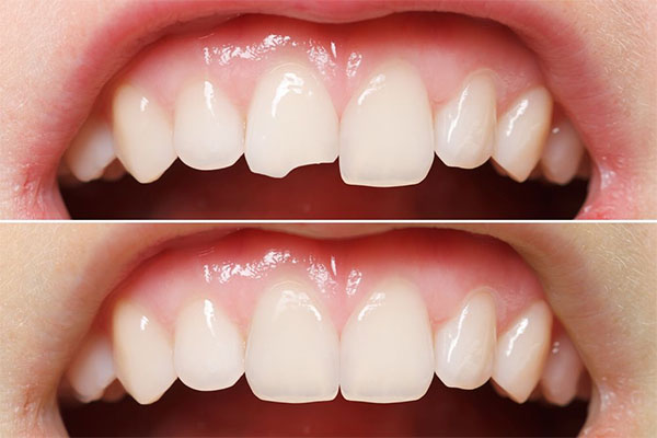 Восстановление зубов - Стоматологическая клиника Железных