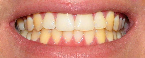 Профессиональное отбеливание зубов - Стоматологическая клиника Железных