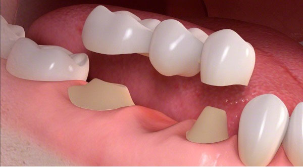 Протезирование зубов - Стоматологическая клиника Железных