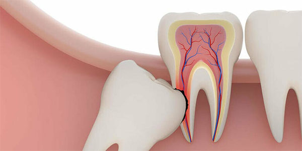 Безболезненное удаление зубов - Стоматологическая клиника Железных